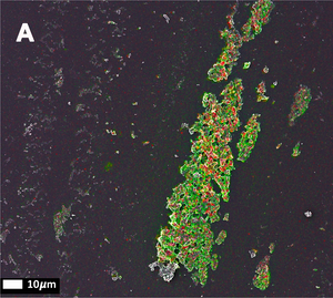 Are amyloid structures in abnormal blood clots a risk factor for amyloidosis?