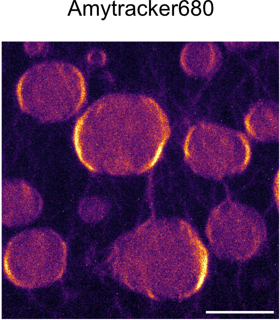 Transition to aggregation in hnRNPA1A condensates visualised using Amytracker