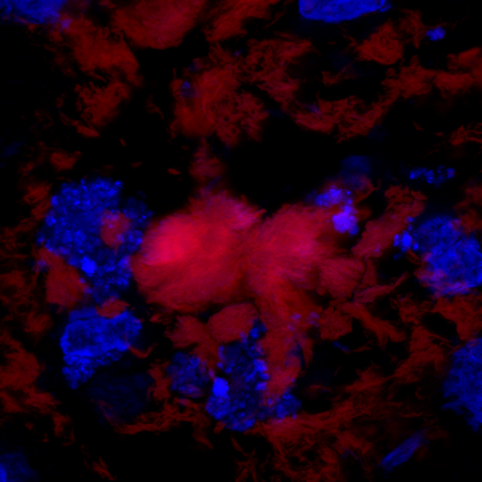 AD pathology in the temporal lobe stained with Amytracker 680 (red) and DAPI (blue). Image ©Ebba Biotech AB